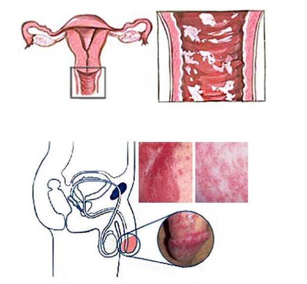Genital candidiasis in women and men as a cause of pathological discharge
