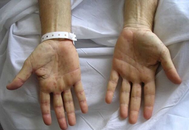 Syphilis on the hands is the cause of pathological discharge from the penis